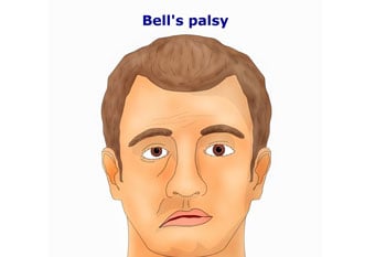 Facial Palsy